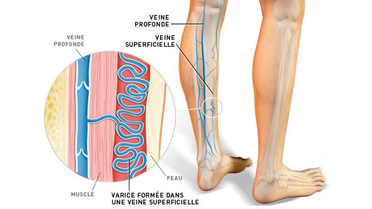 Le Traitement Des Varices Des Membres Inf Rieurs Actualit S Sante Dz