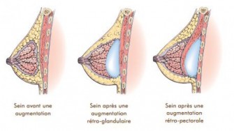 La pose de prothèses mammaires