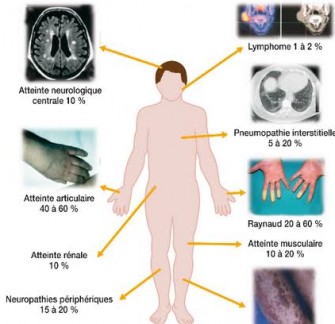 Syndrome de Sj&ouml;gren