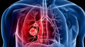 Une nouvelle classification TNM des cancers bronchiques  non à petites cellules