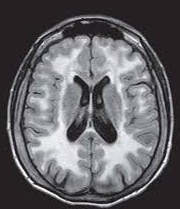 Une leucoencéphalopathie