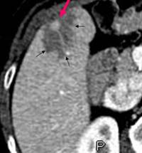 Métastase hépatique d’un insulinome