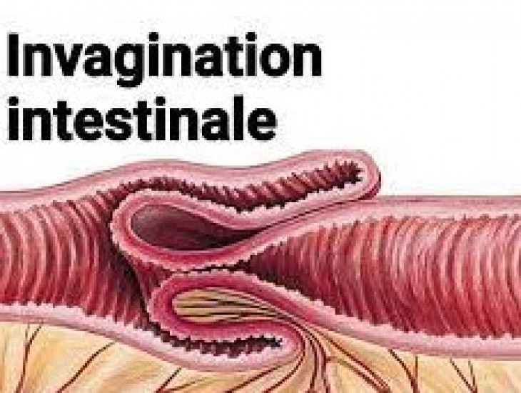 Inglustination Intestinal IInvagination intestinale - Actualités - Sante-dz