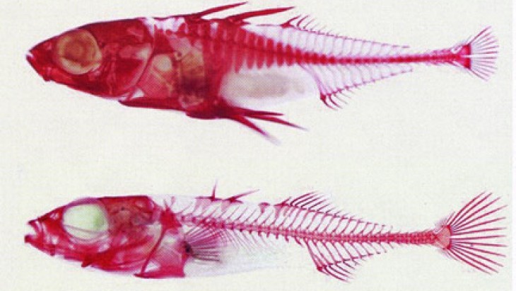 Arête De Poisson Coincée Dans L Oesophage